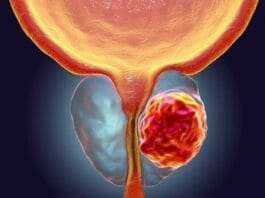 Entre 30 y 50 % de casos de cáncer de próstata en Latinoamérica se detectan tardíamente